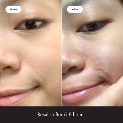 Mighty Patch™ Original Hydrocolloid Acne Patch