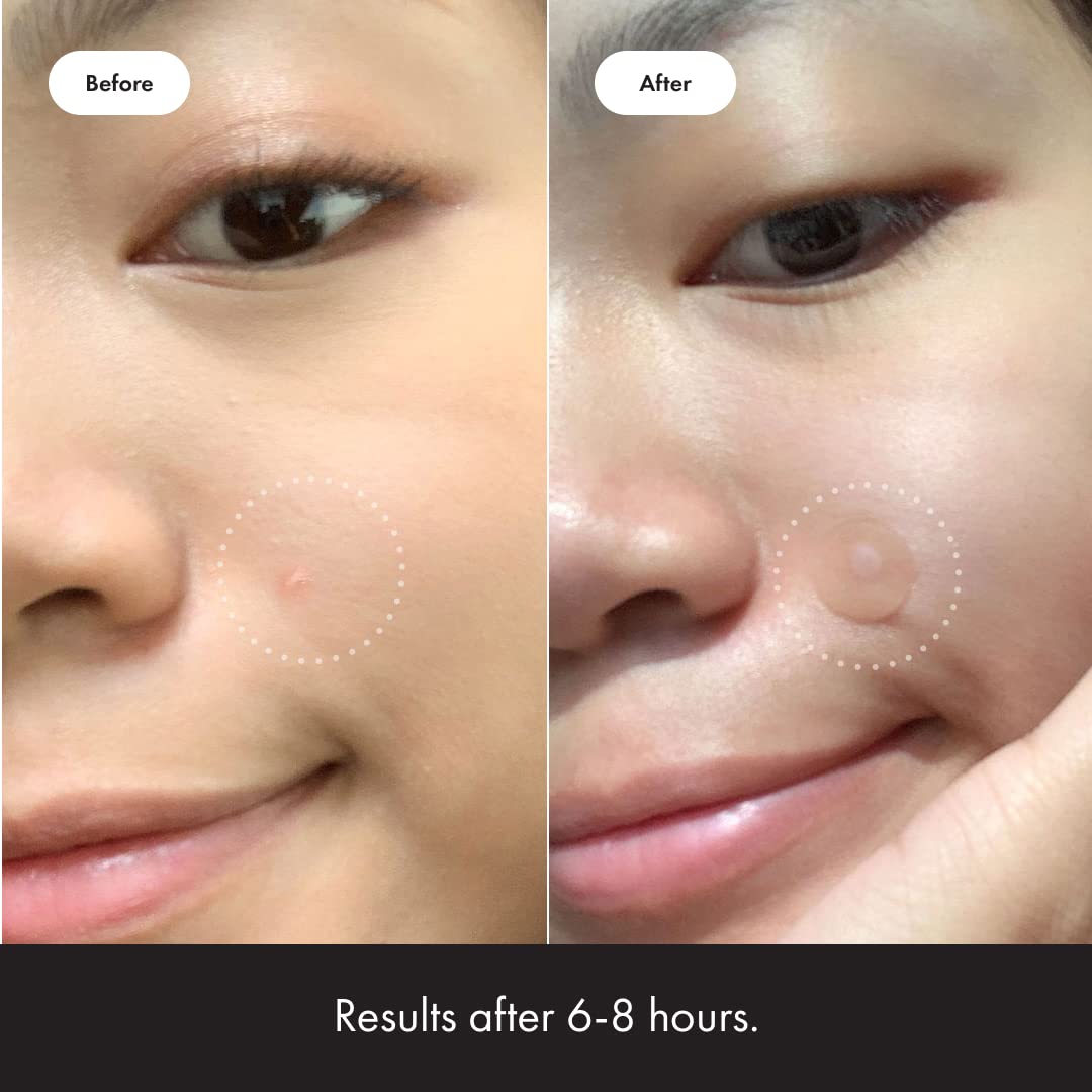 Mighty Patch™ Original Hydrocolloid Acne Patch